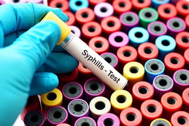 STD Testing for Syphilis