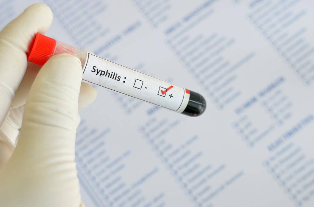 Syphilis testing